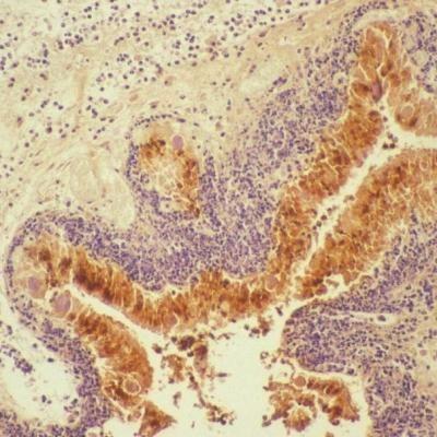 Tincion Inmunocitoquimica Mostrando Una Infeccion Clamidial En Placenta